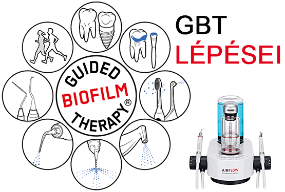 Mindent az Irányított Biofilm Terápiáról, a GBT-ről! II. rész