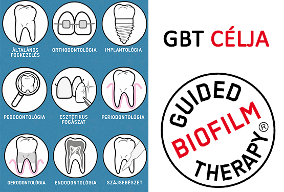 Mindent az Irányított Biofilm Terápiáról, a GBT-ről! I. rész