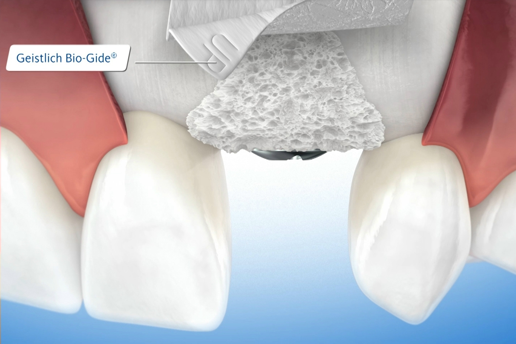 BioGide 13x25mm FrontDent
