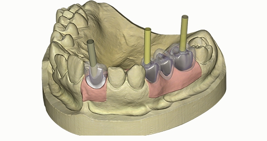 Exocad Implants modul DentalCAD, Perpetual license