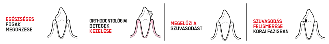 Miért válassza az Irányított Biofilm Terápiát? 1. Egészséges fogak megőrzése 2. Lehetőséget ad orthodontológiai betegek kezelése 3. Megelőzi a szuvasodást 4. Szuvasodás felismerése korai fázisban