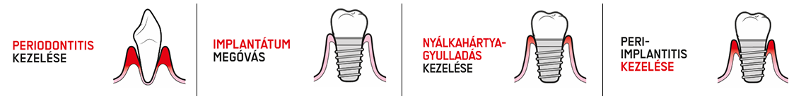 9. Periodontitis kezelése 10. Implantátum megóvás 11. Nyálkahártya-gyulladás kezelése 12. Peri- implantitis kezelése