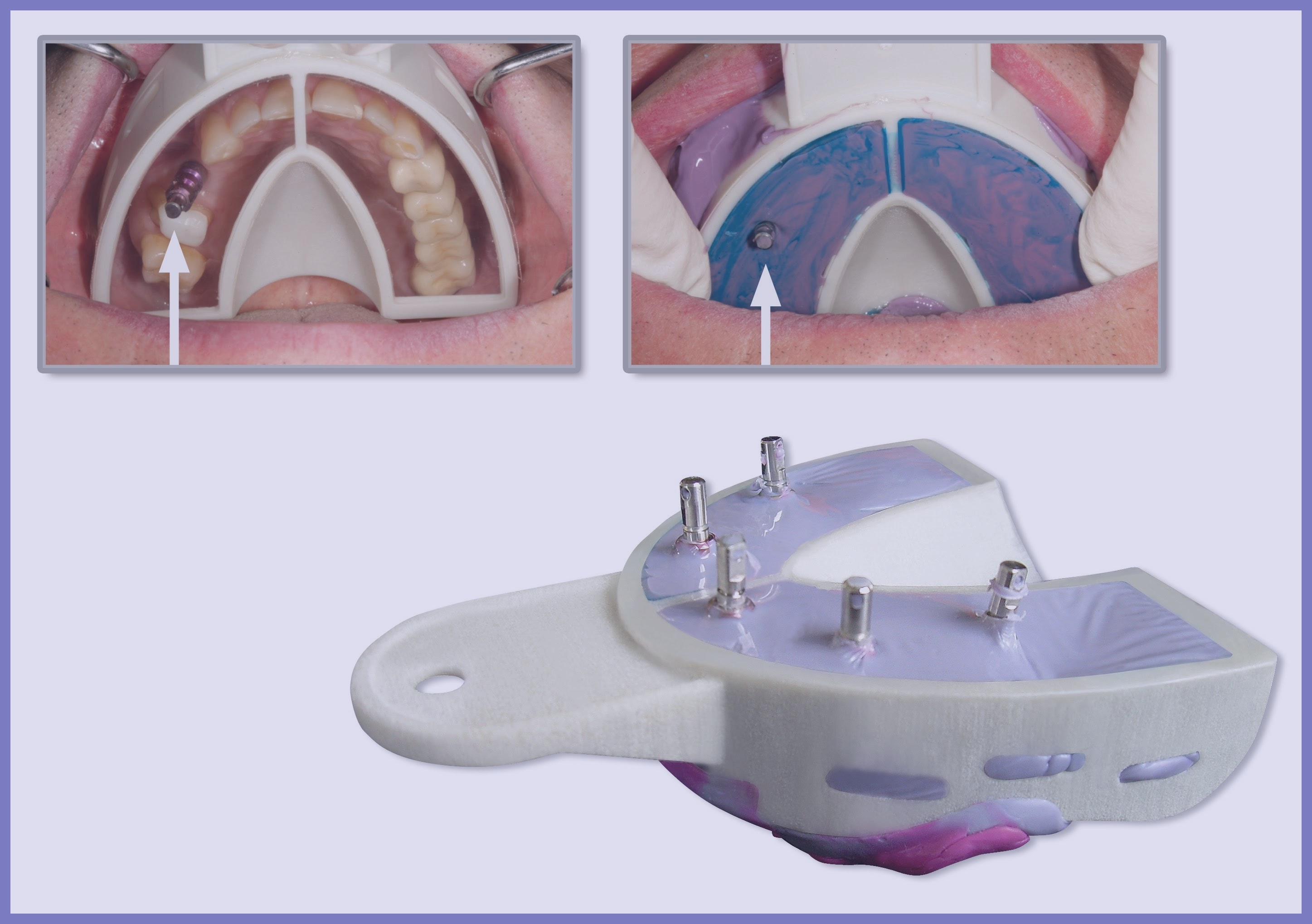 Miratray Implant - a LILA az igazi!