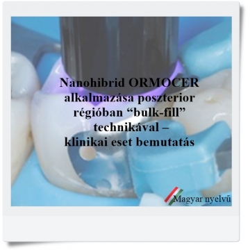 Nanohibrid ORMOCER alkalmazása poszterior régióban “bulk-fill” technikával