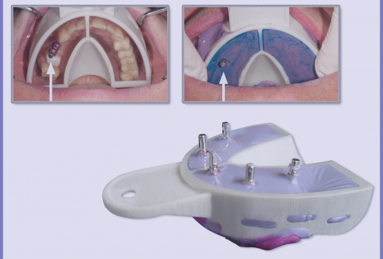 Miratray Implant - a LILA az igazi!