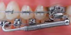 Forsus EZ2 Module Right Reorder