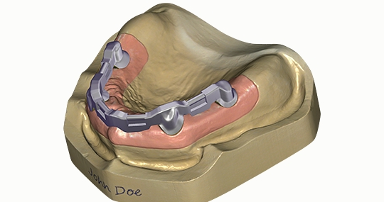 Exocad Bars add-on modul DentalCad, Perpetual license