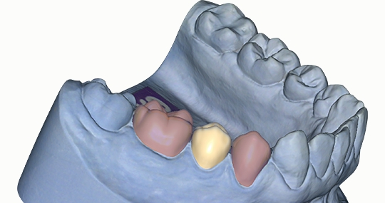 Exocad Provisionals add-on modul DentalCAD, Perpetual License