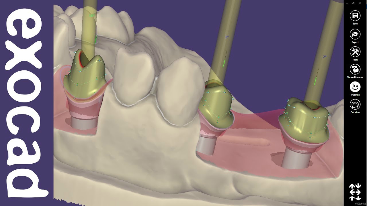 EXOCAD Implant Lab Bundle (Perpetual License)